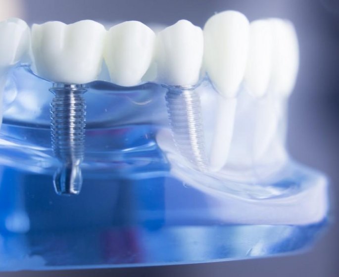 5 choses que vous ne savez pas sur les couronnes dentaires