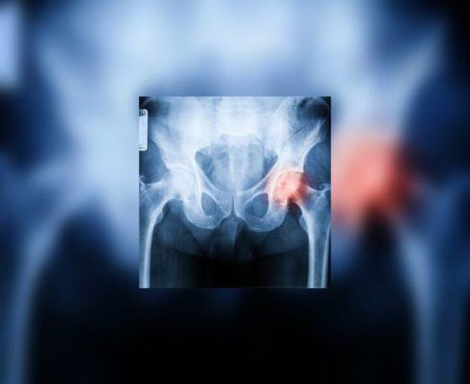 Protheses de hanche : l’avenir en 3D !