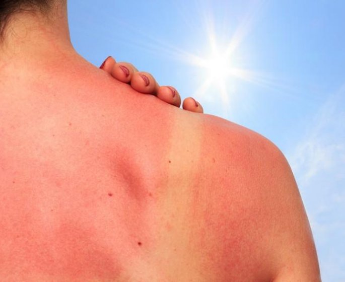 Ultraviolets : les consequences du soleil sur notre peau