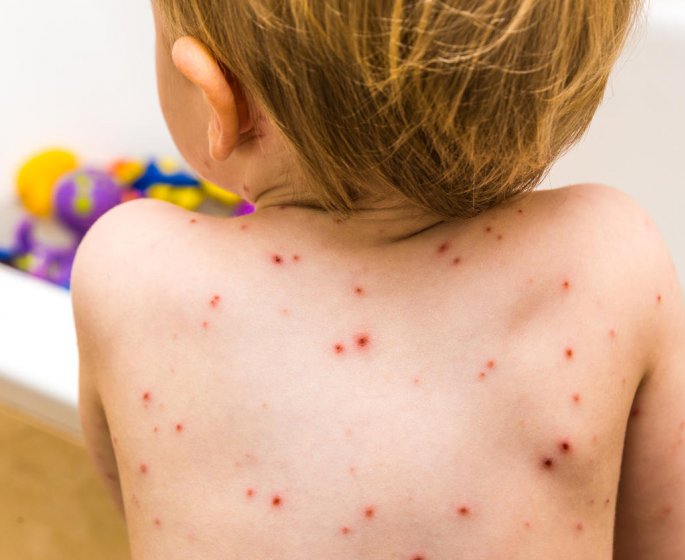 L’epidemie de varicelle arrive en France