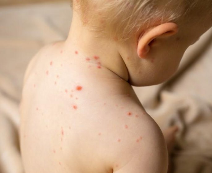 La varicelle progresse dans plusieurs regions de France