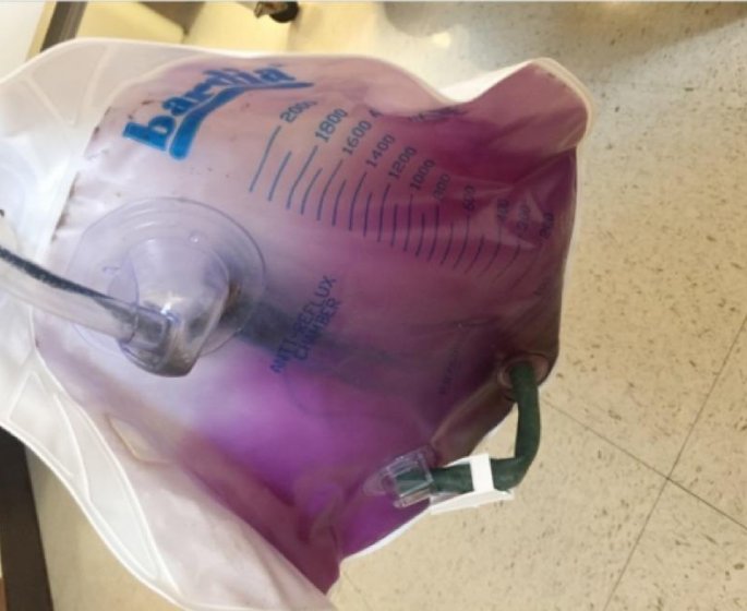Des patients hospitalises ont une urine violette
