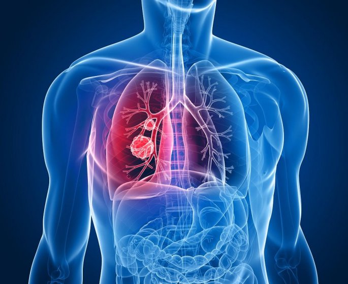Cancer du poumon : il serait possible de se passer de chimiotherapie