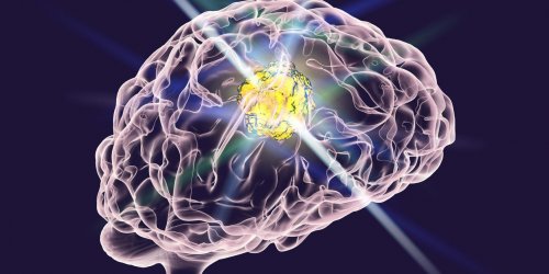 Tumeur au cerveau : des causes mal connues