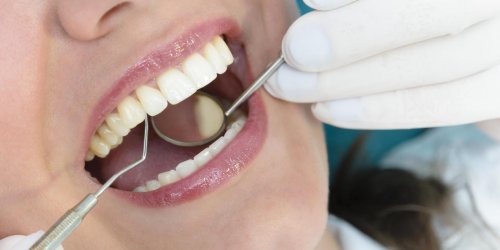 Soins dentaires rembourses a 100% : comment va faire l’Assurance maladie ?