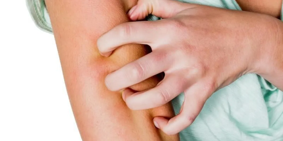 une femme a une peau qui démange après une piqûre de moustique et se gratte une femme a une peau qui démange après une piqûre de moustique et se gratte