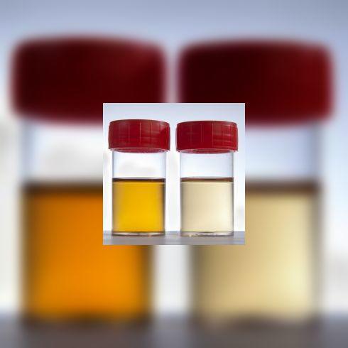 Changement de couleur de l'urine