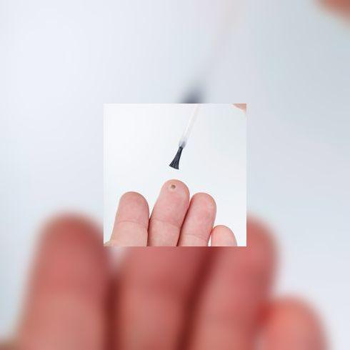 Comment soigner une verrue ?