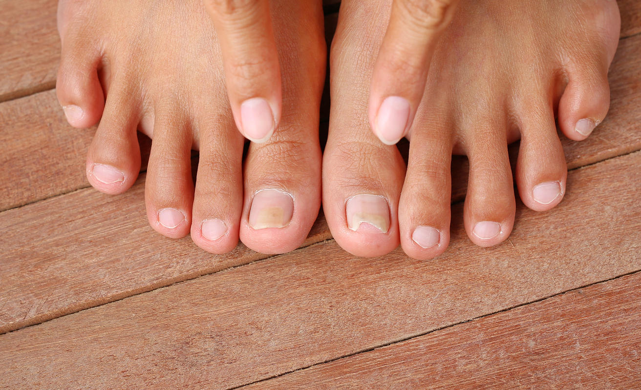 Ongle Ecrase Ou Arrache Ongle Ecrase Ou Arrache