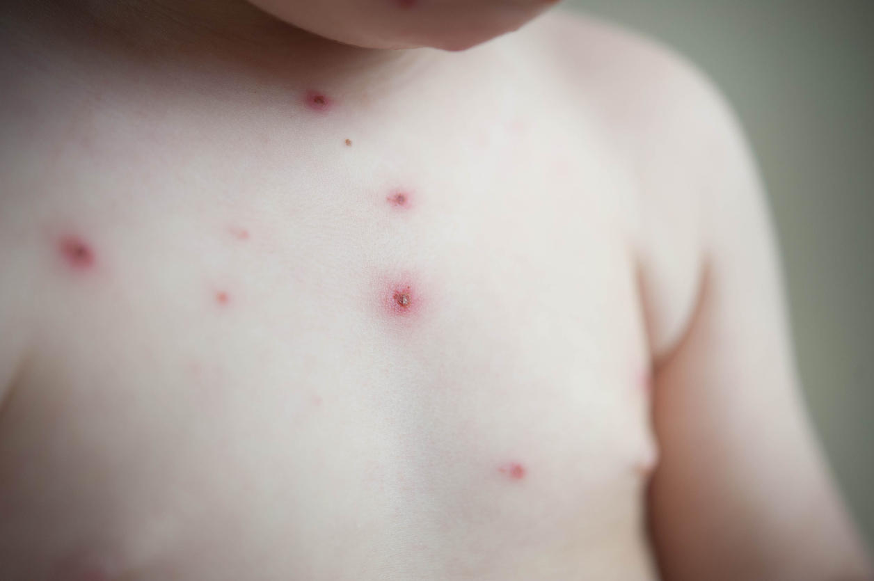 Comment reconnaître un bouton de varicelle