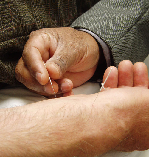 Photo d&apos;une séance d&apos;acupuncture