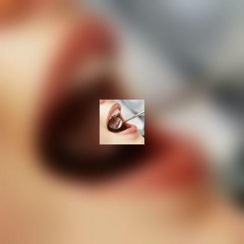 cancer glande salivare simptome