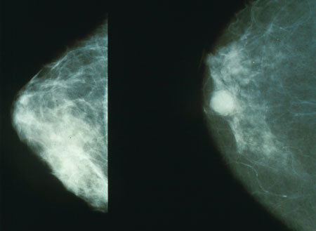 Photo : mammographie montrant un cancer du sein à droite