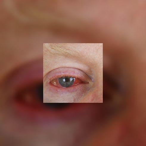 Irritation de l'œil: causes et traitements des irritations de l'œil,