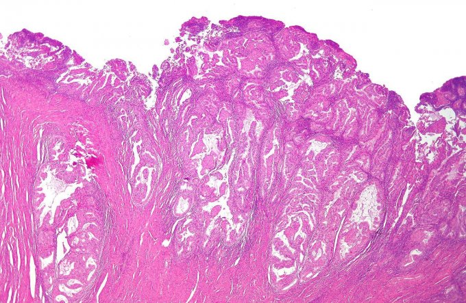 Image : coupe histologique d&apos;un adénocarcinome endométrioïde, forme la plus fréquente de cancer de l&apos;endomètre