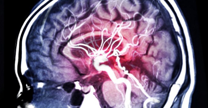 Les signes d’un accident vasculaire cérébrale qui doivent vous alerter
