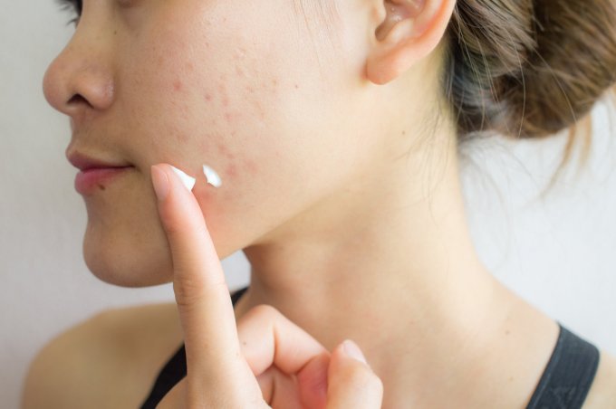 portrait of young asian woman having acne problem applying acne cream on her face