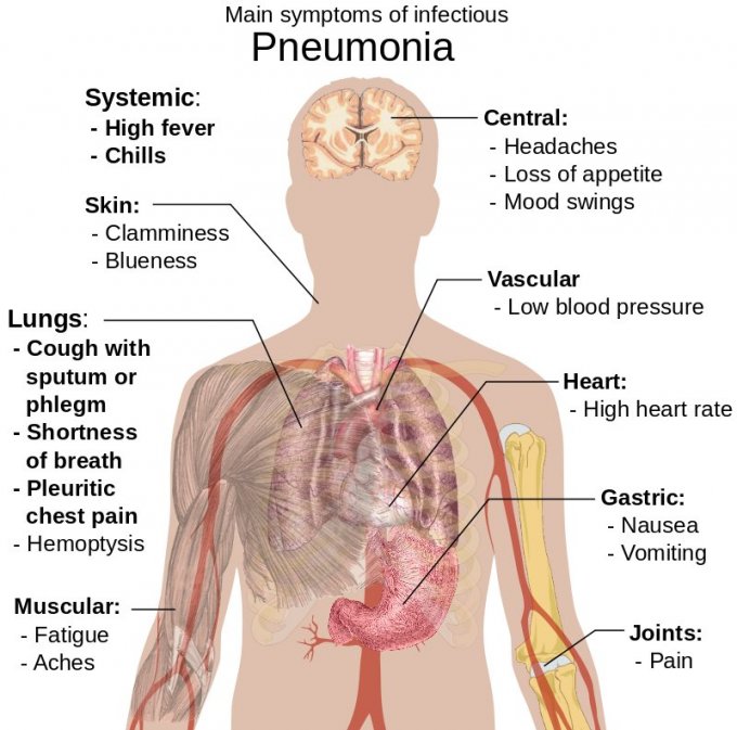 Infographie : les principaux symptômes de la pneumonie
