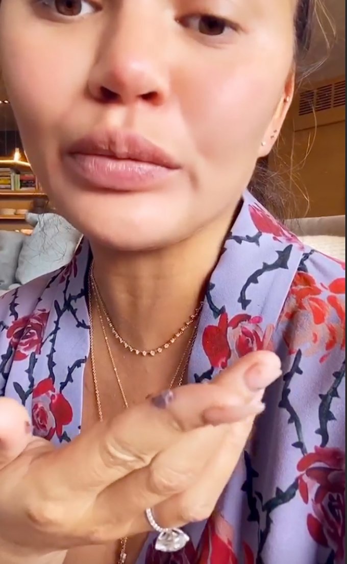 Chrissy Teigen : les photos de sa langue ravagée