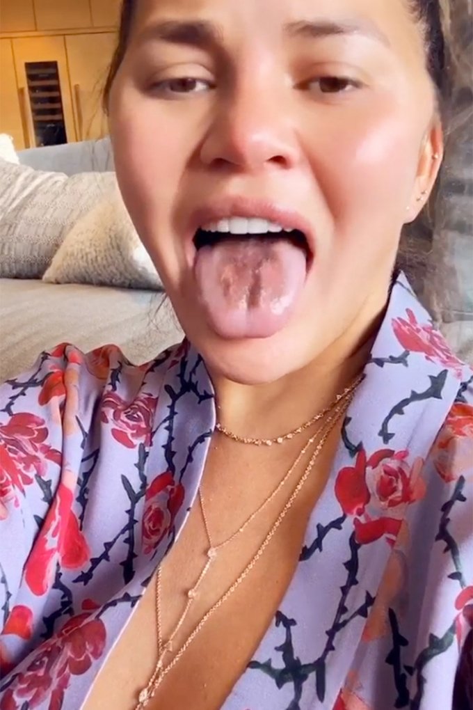 Chrissy Teigen : les photos de sa langue ravagée