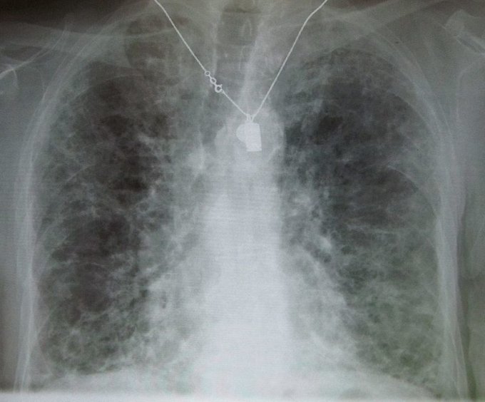 Radio d&apos;une fibrose pulmonaire