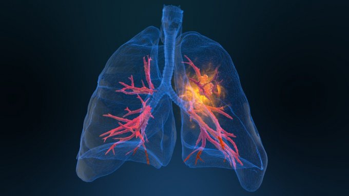 Cancer du poumon : êtes-vous à risque ?