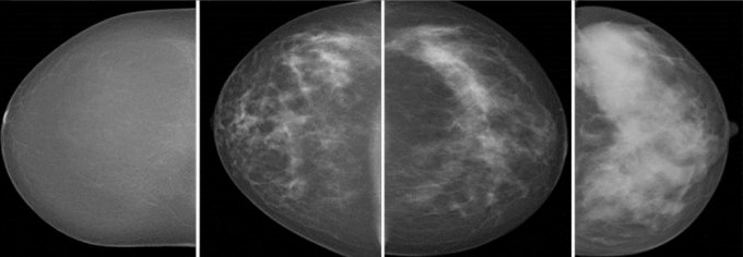 Seule une mammographie peut apprécier la densité du sein