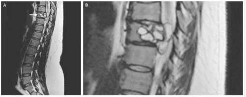 &lt;strong&gt;Une infection tr&egrave;s rare&lt;/strong&gt;