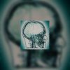 Rupture d'anévrysme - anévrysme de l'aorte