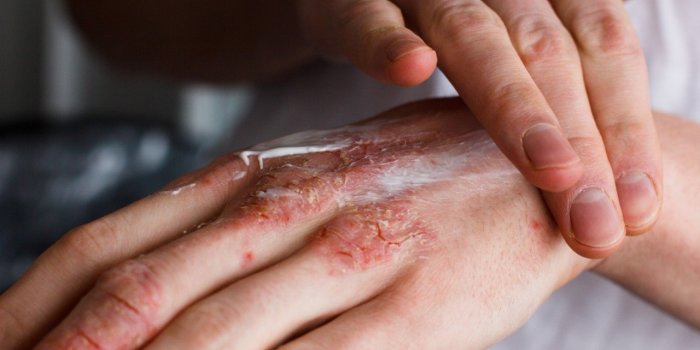Coronavirus : comment prendre soin des mains abîmées par les lavages fréquents ?