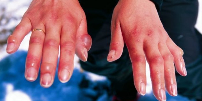 Taches sur les mains, langue gonflée, brûlures⦠les signes de la covid-19 méconnus