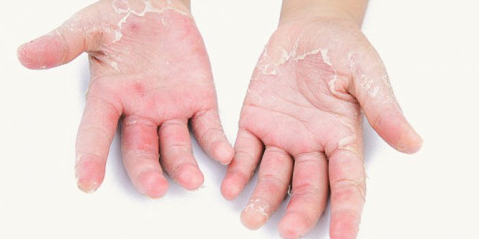 Taches sur les mains, langue gonflée, brûlures⦠les signes de la covid-19 méconnus