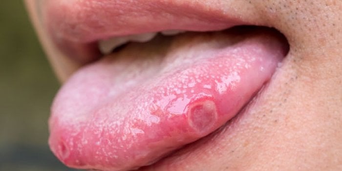 Taches sur les mains, langue gonflée, brûlures⦠les signes de la covid-19 méconnus