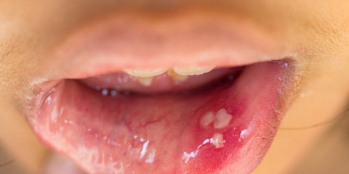 Taches sur les mains, langue gonflée, brûlures⦠les signes de la covid-19 méconnus