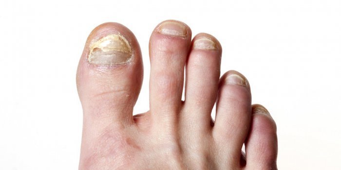 Ongle Covid : 5 signes que vous avez été infectés par le coronavirus