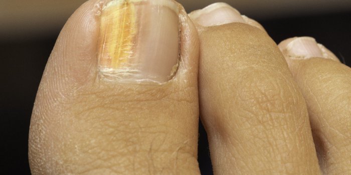 Ongle Covid : 5 signes que vous avez été infectés par le coronavirus