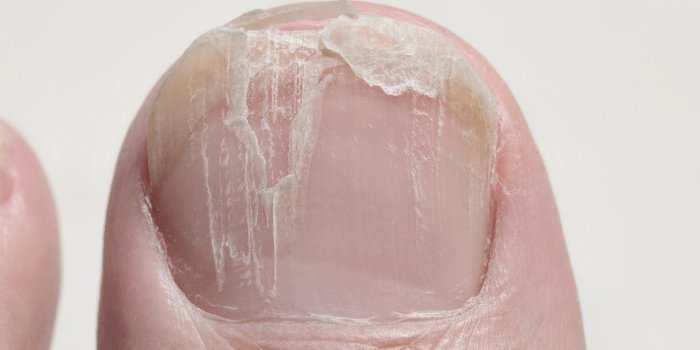 Ongle Covid : 5 signes que vous avez été infectés par le coronavirus