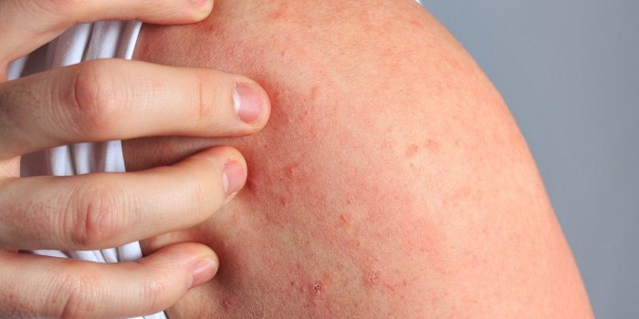 Dengue : 5 symptômes à repérer