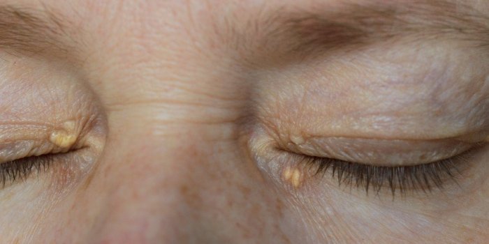 Cholestérol : 9 signes qui montrent que vous en avez trop
