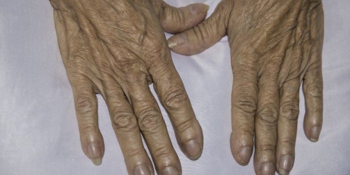 Insuffisance respiratoire : 9 signes à repérer