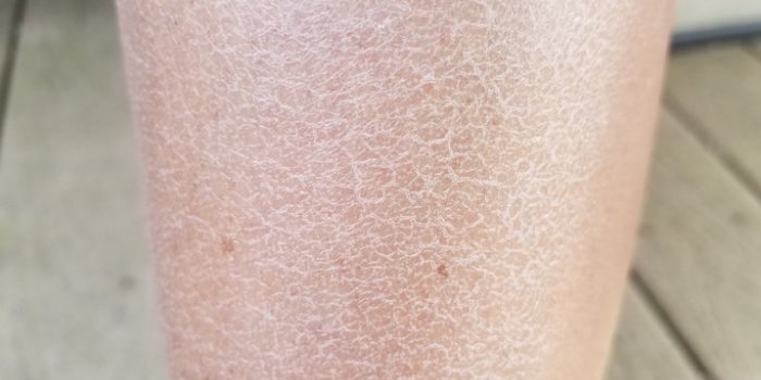 Vitamine C : 12 signes de carence à repérer