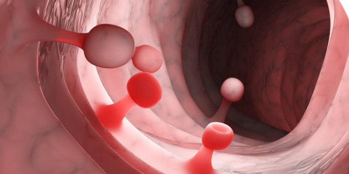 Cancer colorectal : 10 facteurs de risque à connaître