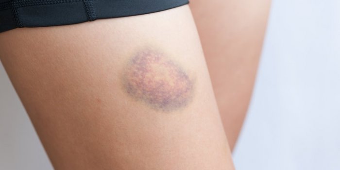 Cancer du sang : les symptômes à repérer