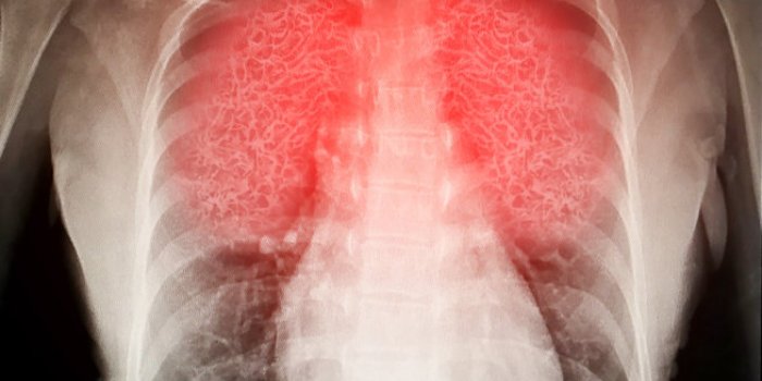 Poumon, foie, cÅur : les complications de la covid-19 Ã craindre
