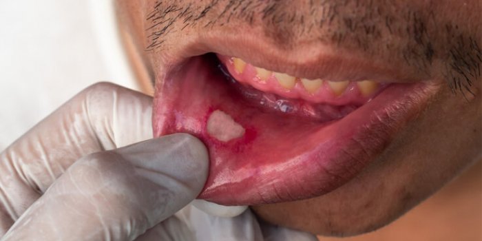 5 symptômes de cancer buccal à surveiller