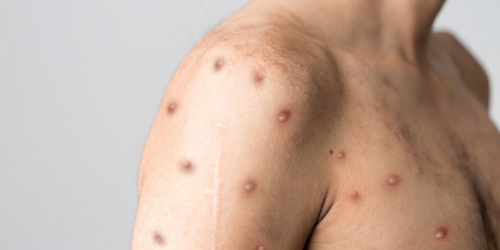 Variole du singe : les symptômes à connaître