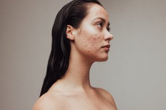 Acne adulte : les meilleurs remedes