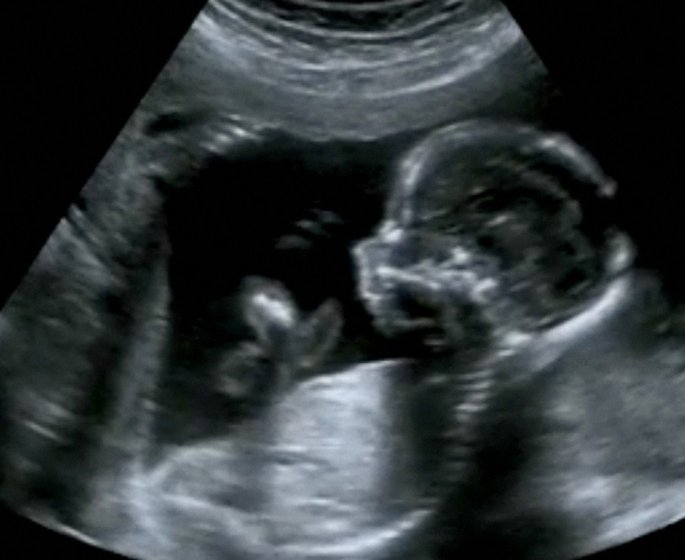 Une petite fille nait avec ses organes a l’exterieur de son corps