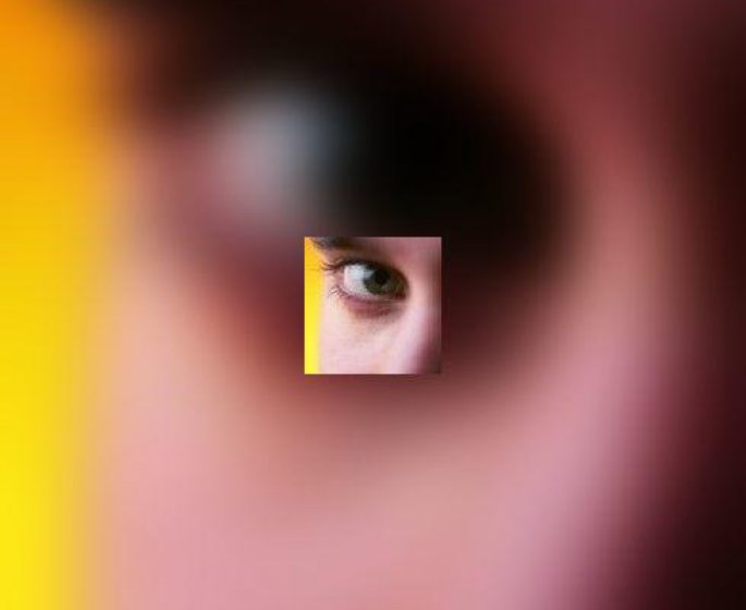Le glaucome : ouvrons les yeux avant qu-il ne soit trop tard