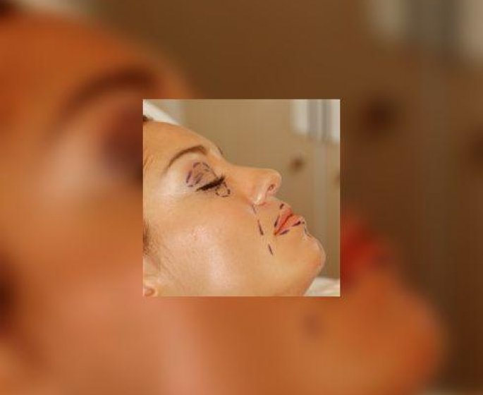 Que savoir sur l’operation chirurgicale esthetique des paupieres ?